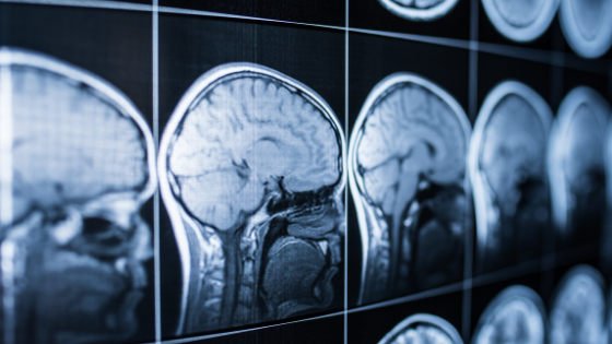 Brain Injury Awareness